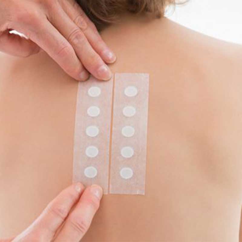 Urticaria: cuándo consultar y qué información llevar